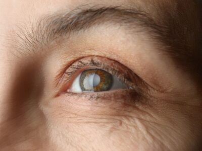 Cataracts Treatment Options